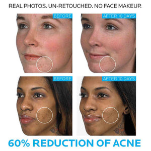 La Roche-Posay Effaclar Duo Acne Spot Treatment La Roche-Posay