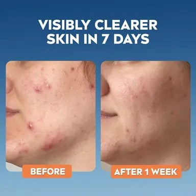 Nivea derma skin clear wash gel 150ml deep cleansing salicylic acid face wash