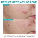 https://allurify.pk/products/la-roche-posay-effaclar-salicylic-acid-acne-serum?_pos=1&_psq=effaclar+salicylic&_ss=e&_v=1.0
