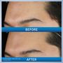 CeraVe Acne Foaming Cream Wash (Expiry) 06-2027