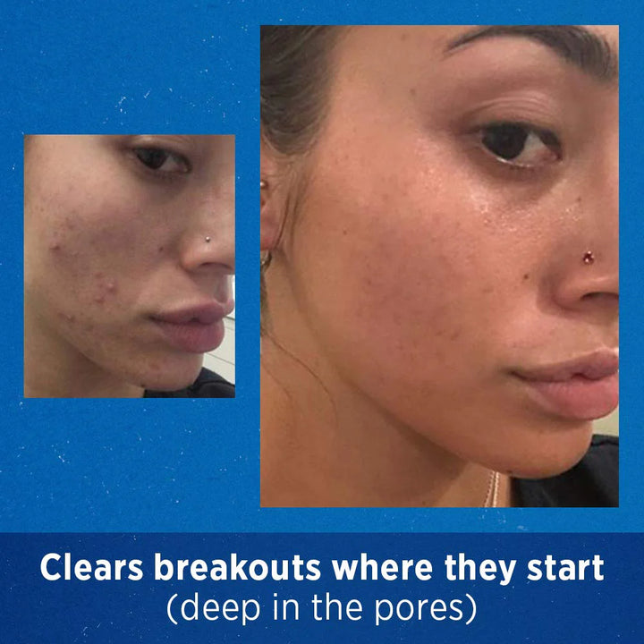 https://allurify.pk/products/differin-gel?variant=51743219614012