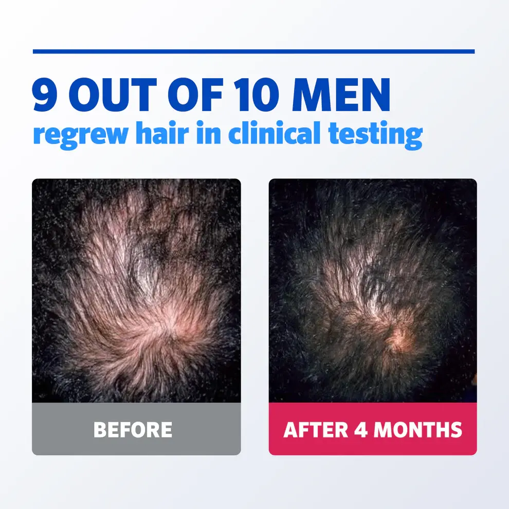 Rogaine Foam Men's Hair Regrowth Treatment 60g (3-Months Supply)