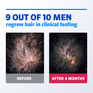 Rogaine Foam Men's Hair Regrowth Treatment 60g (3-Months Supply) Rogaine