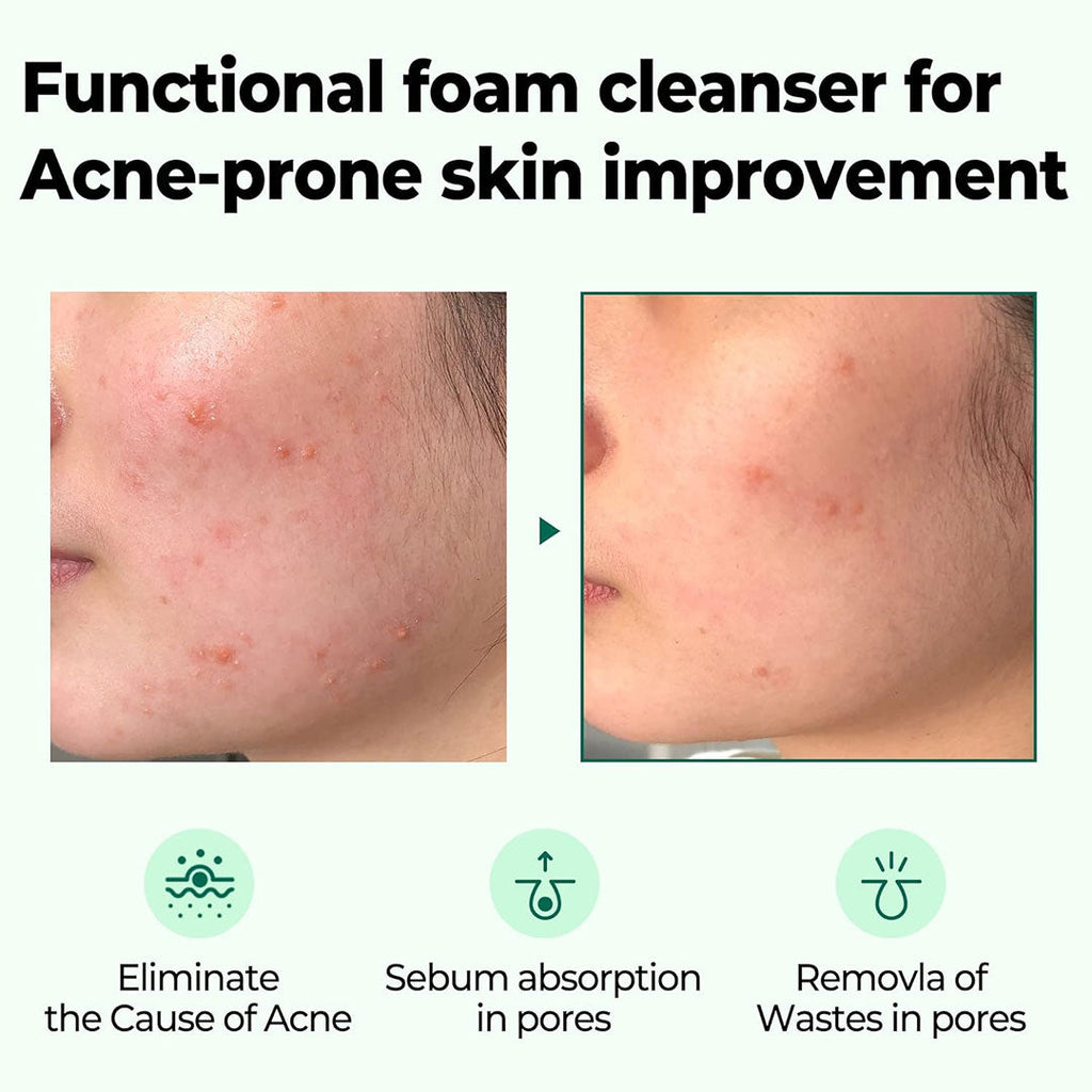 https://allurify.pk/products/some-by-mi-aha-bha-pha-30-days-miracle-acne-clear-foam?_pos=1&_psq=acne+aha+bha&_ss=e&_v=1.0