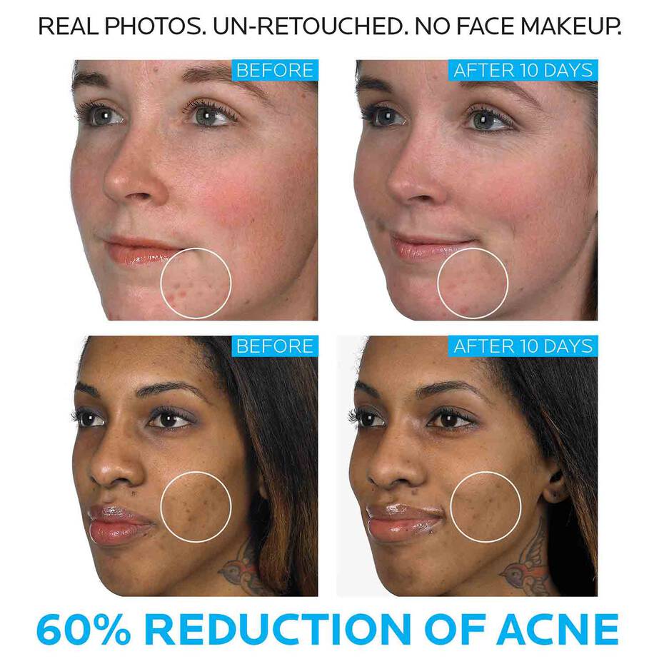 La Roche-Posay Effaclar Duo Acne Spot Treatment (Exp 2/2026)